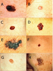 Test yourself: which do you think are malignant skin cancers? Click to enlarge. Answers at bottom of post.